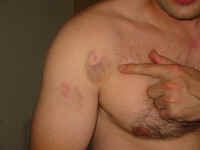 tonks_paintball_injury.jpg (79125 bytes)